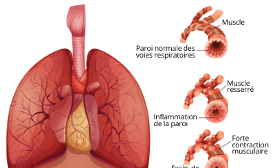 990- L´asthme: Causes, symptômes et traitement naturel de l´asthme