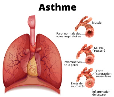 990- L´asthme: Causes, symptômes et traitement naturel de l´asthme