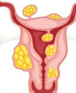 Fibromes : Les Meilleurs Remèdes Naturels Contre les Fibromes