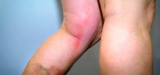 La Thrombose Veineuse : Définition Causes et Solution Naturelle