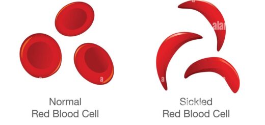 La Drépanocytose : définition causes symptômes et traitement naturel