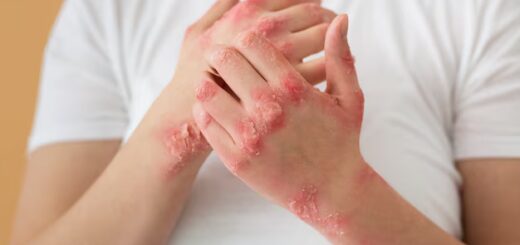 Impétigo: Causes, symptômes et remède naturel contre l´impétigo