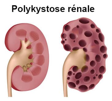 Définition symptômes de kyste rénal