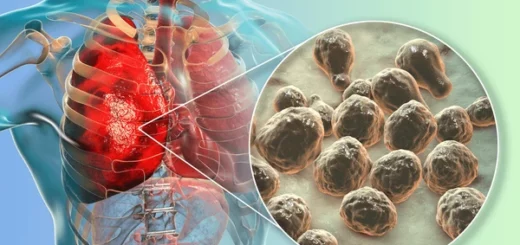 La Cryptococcose : Définition Causes et Traitement Naturel La Cryptococcose