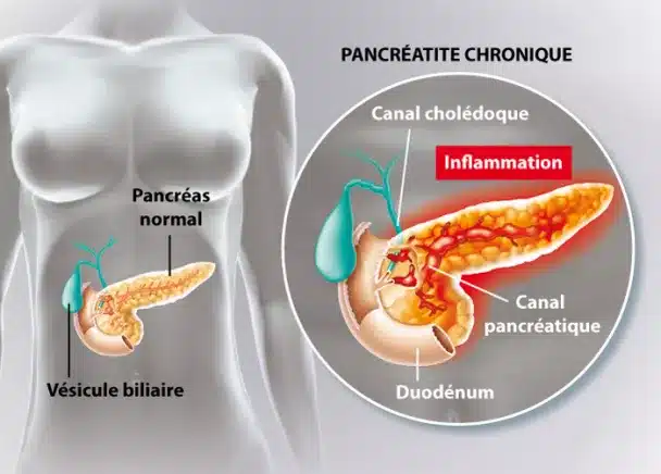 Traitement naturel de la pancréatite