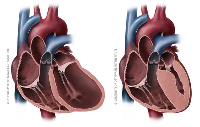 Soin naturel pour la cardiopathie ischémique