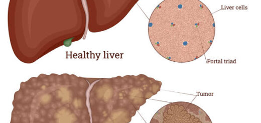 Cancer du Foie : Causes , Symptômes et Soin Naturel du Cancer Du Foie