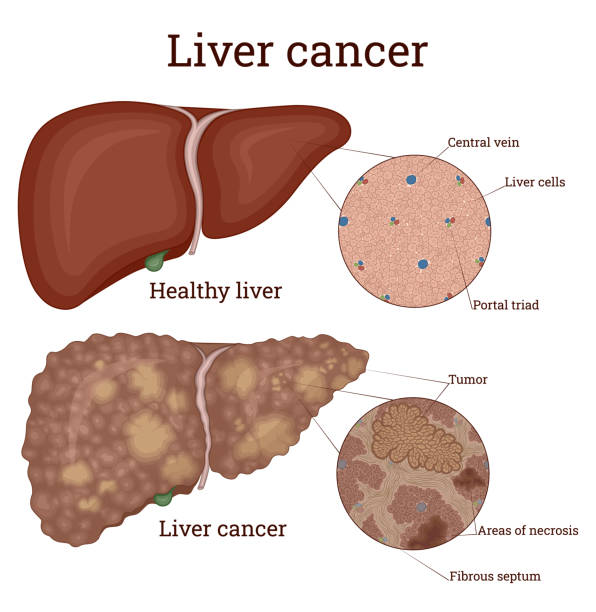 Cancer du Foie : Causes , Symptômes et Soin Naturel du Cancer Du Foie