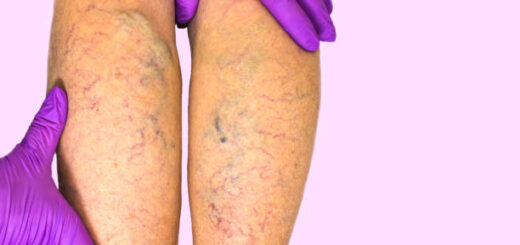 Insuffisance Veineuse: Causes, symptômes et traitement naturel % de l´insuffisance veineuse