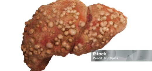 Cancer du foie: Causes, symptômes et traitement % naturel du Cancer du foie