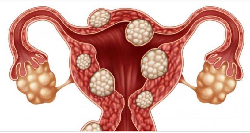 Fibrome Utérin : Causes et Traitement des Fibromes de l'Utérus