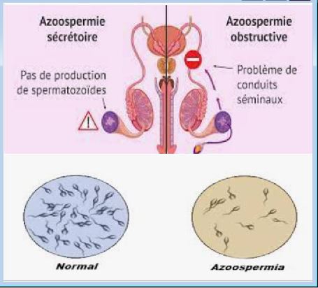 Comment Soigner Une Asthénospermie