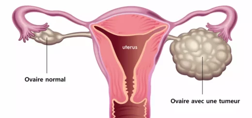 Cancer Ovarien Causes Symptômes Traitement Naturel Cancer Ovarien