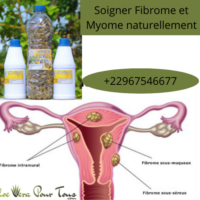 Soigner Fibrome et Myome naturellement