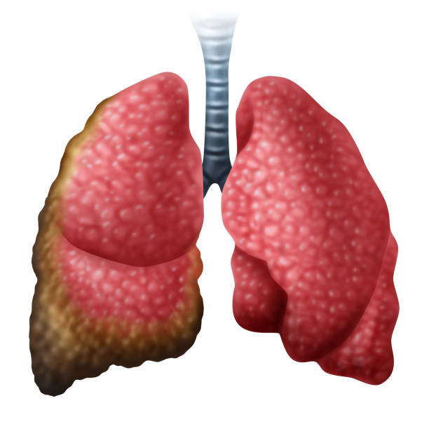 Mucoviscidose Causes Symptômes Traitement Naturel Mucoviscidose