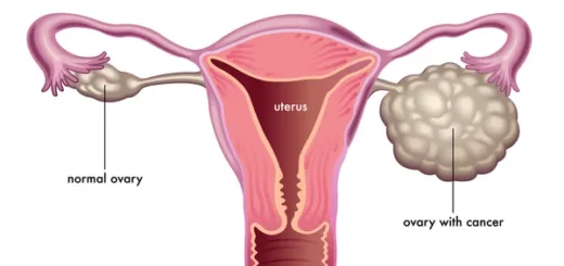 Cancer Ovarien Causes Symptômes Traitement Naturel Cancer Ovarien