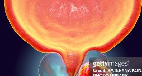 Cancer de la Prostate Causes Symptômes Traitement Naturel