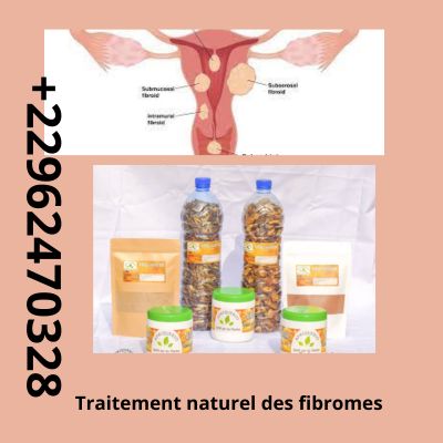 Soigner Fibromes, myomes: Traitement 100% Naturel des Fibromes