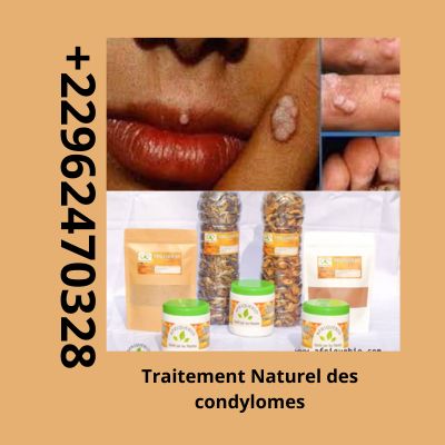 Comment soigner les condylomes: Traitement 100% Naturel des Condylomes