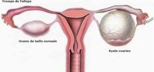 Kyste Ovarien Grossesse Et Alimentation