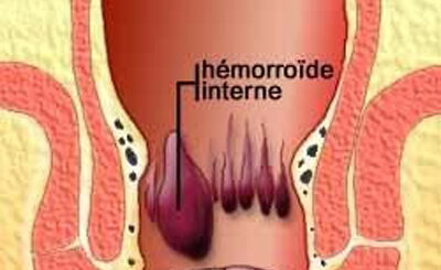 Hémorroïdes Causes Traitement Naturel