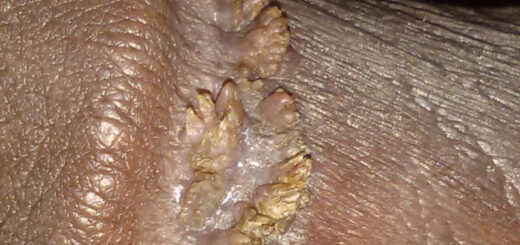 Condylomes: Solution naturelles contre les condylomes