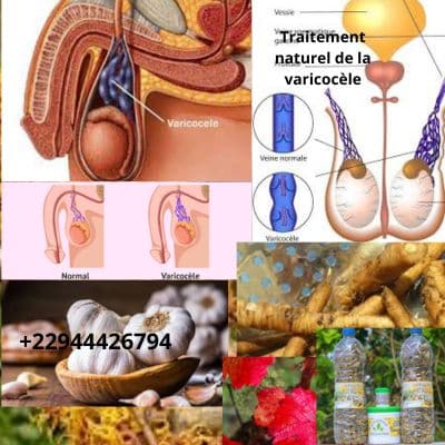 Comment soigner la varicocèle et devenir très fécond? Remède naturel