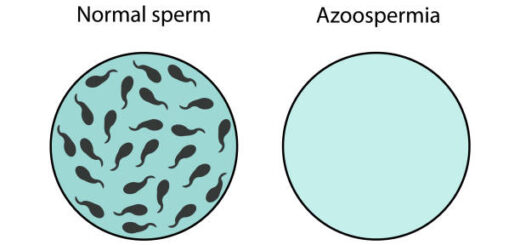 Comprendre l´azoospermie: Traitement 100 % naturel