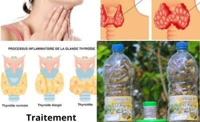 Comment soigner la Thyroïdite? Traitement naturel de la thyroïdite