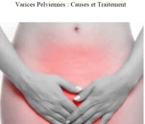 Varices pelviennes traitement naturel varices pelviennes