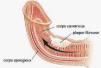 Maladie de Lapeyronie : Cause et un traitement Naturel