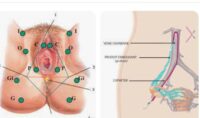 Varices pelviennes traitement naturel varices pelviennes