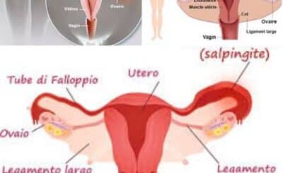 Comment soigner la salpingite? Traitement 100 % Naturel de la salpingite