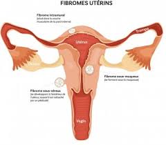 Comment soigner les fibromes? Traitement 100 % naturel des fibromes