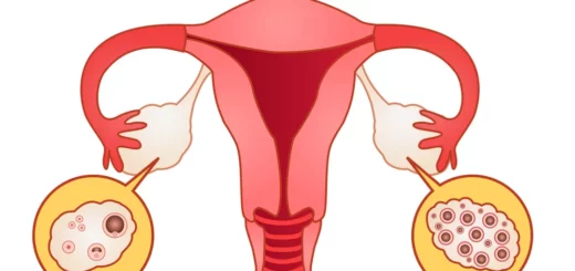 Syndrome des ovaires polykystique (SOPK): Solution naturelle contre SOPK