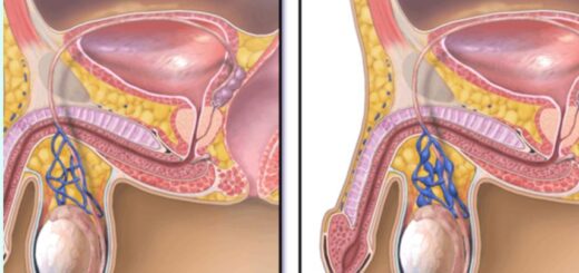 Varicocèle : Seule Solution de Guérison