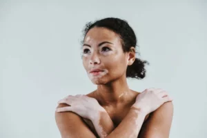 Traitement naturel contre le vitiligo