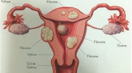 Recettes Enlever Fibrome Naturellement