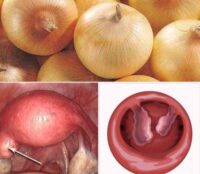 Classification des Fibromes