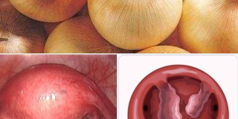 Classification des Fibromes