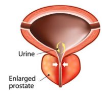 Remède naturel Cancer de la Prostate