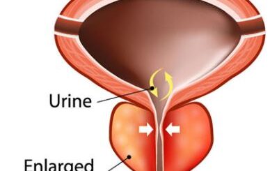Remède naturel Cancer de la Prostate