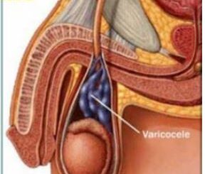 La Varicocèle Provoque t-elle L'infertilité ?
