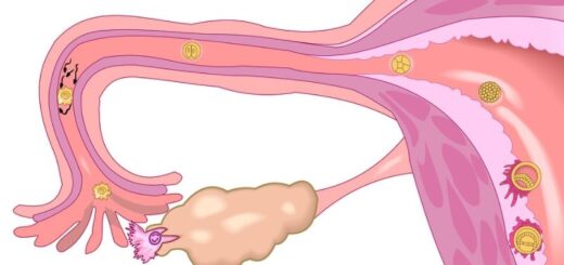 Trompe de Fallope bouchée : causes, symptômes, traitement naturel