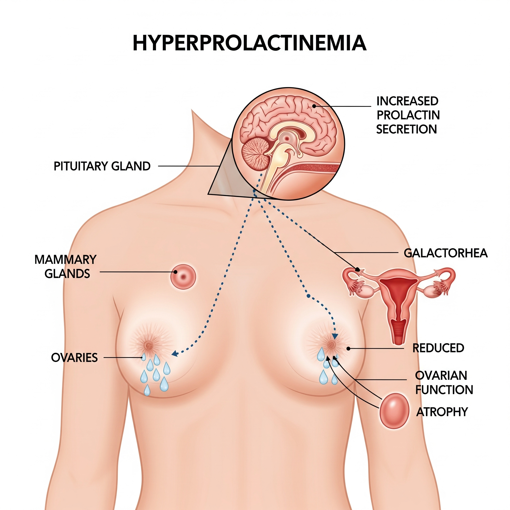 Tisane Africaine pour Hyperprolactinémie