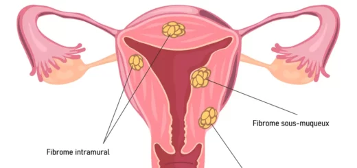 Libérez-vous des fibromes sous-muqueux sans chirurgie