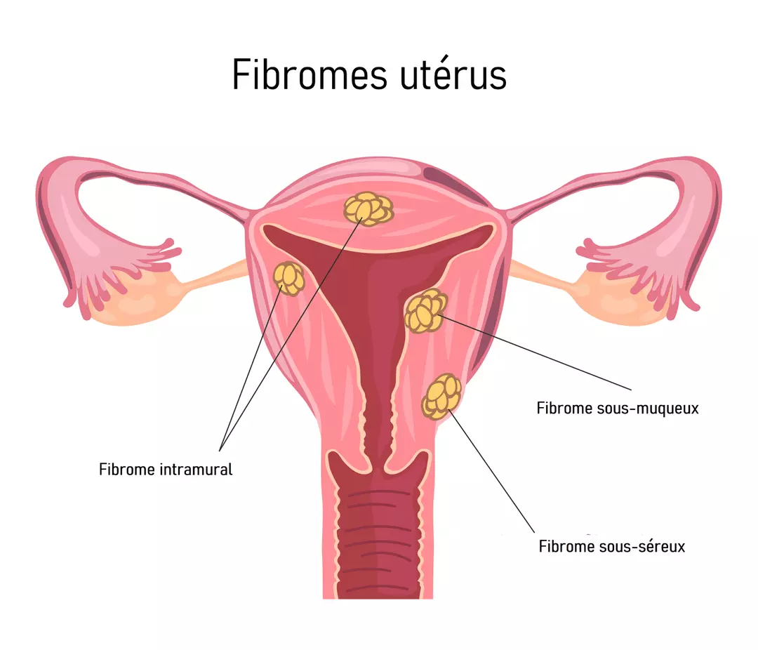 Libérez-vous des fibromes sous-muqueux sans chirurgie