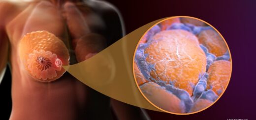 Plantes miraculeuses pour renforcer le Cancer du sein